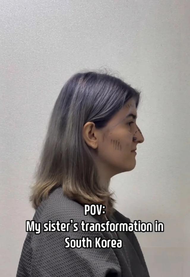 A side profile of the woman before surgery, showing her natural features, taken during the initial stage of her transformation journey.